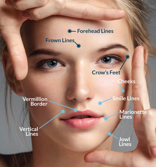 Botulinum toxin injections at 