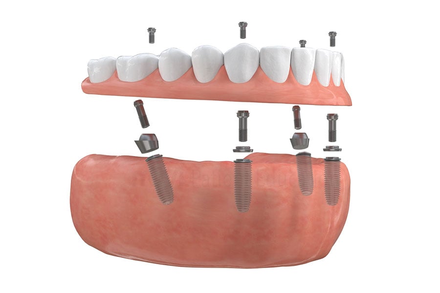 Full-arch implant-supported bridge at 