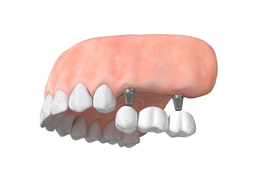 Implant-supported dental bridge at 