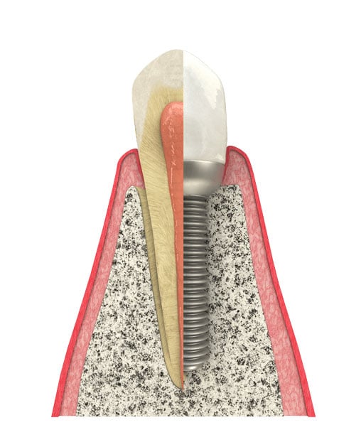 Dental implant model showing titanium post, abutment, and crown