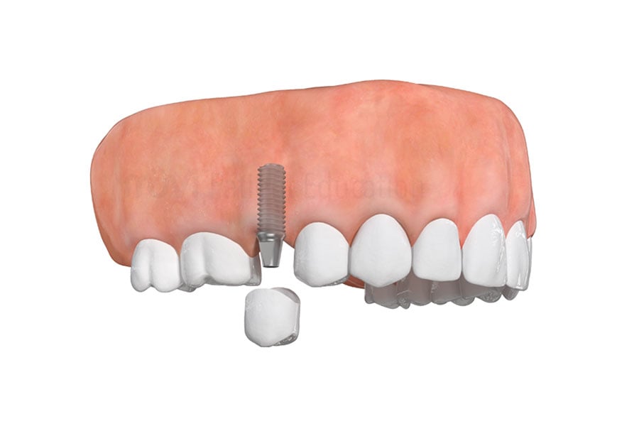 Single dental implant at 