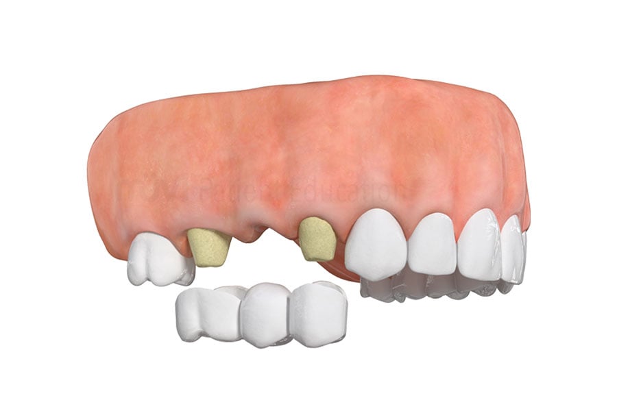 Traditional dental bridge comparison