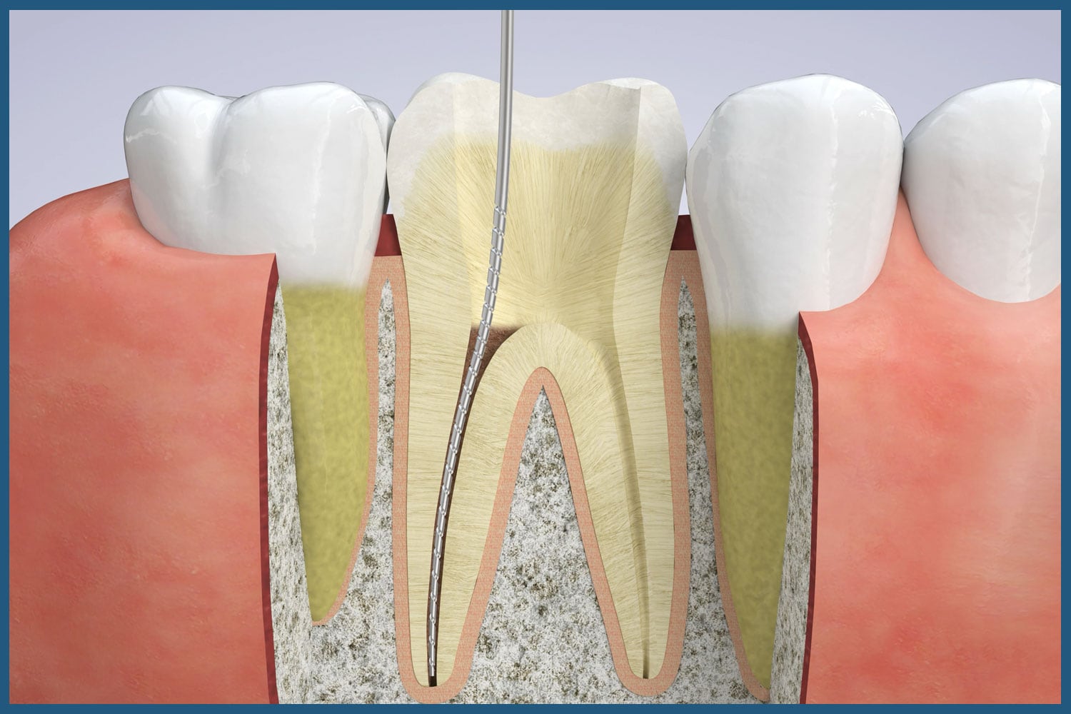 Stages of root canal therapy at 