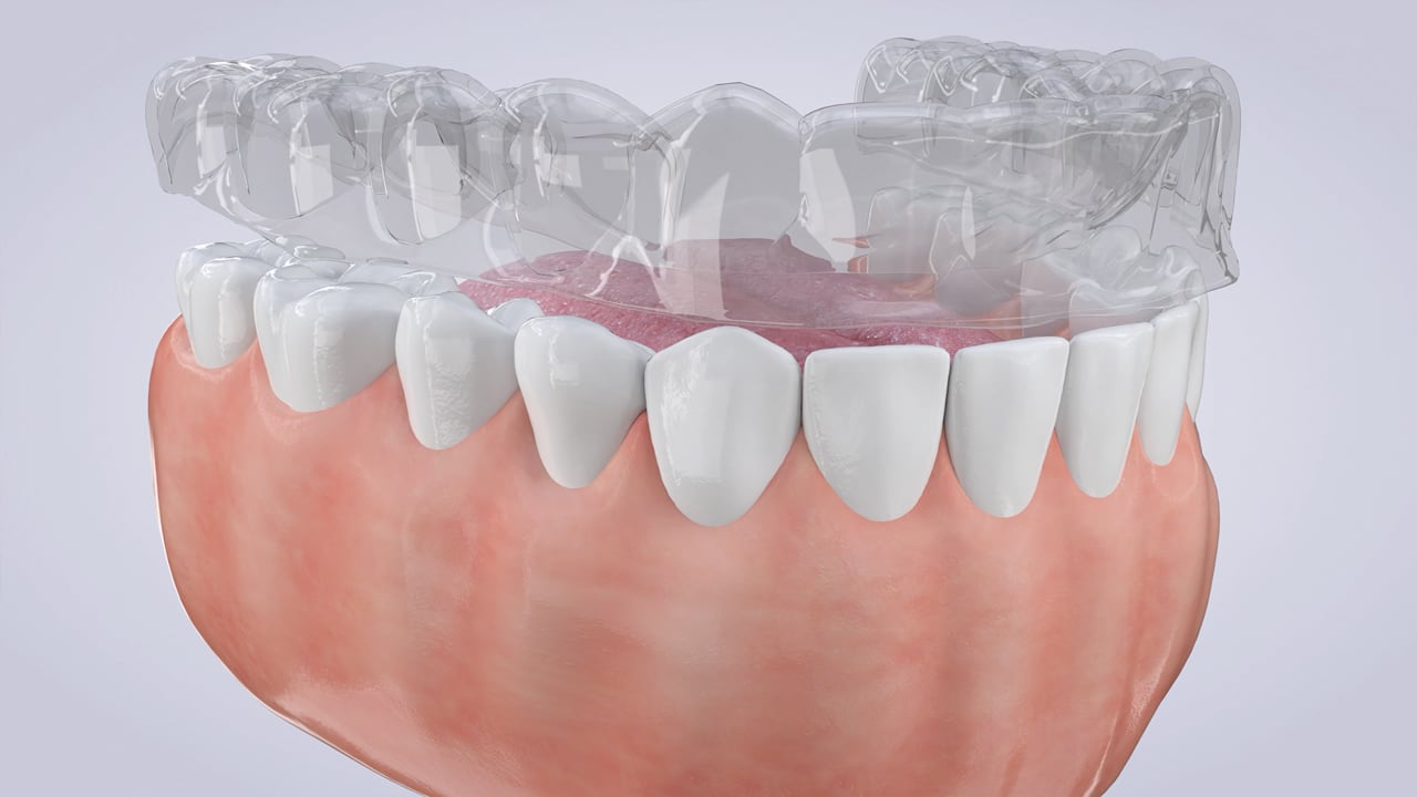 Poster image for the Clear Aligners patient-education video